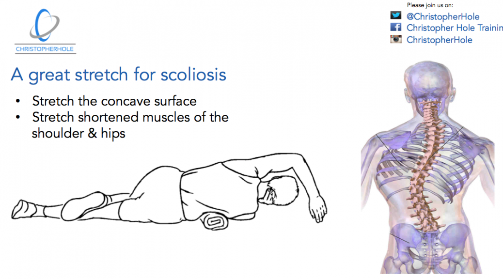 Scoliosis The Basics Of An Exercise